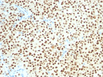 FFPE human melanoma sections stained with 100 ul anti-SOX10 (clone SOX10/1074) at 1:50. HIER epitope retrieval prior to staining was performed in 10mM Citrate, pH 6.0.